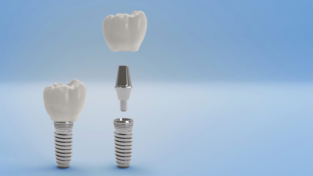 Dental Implants in Argyle, TX