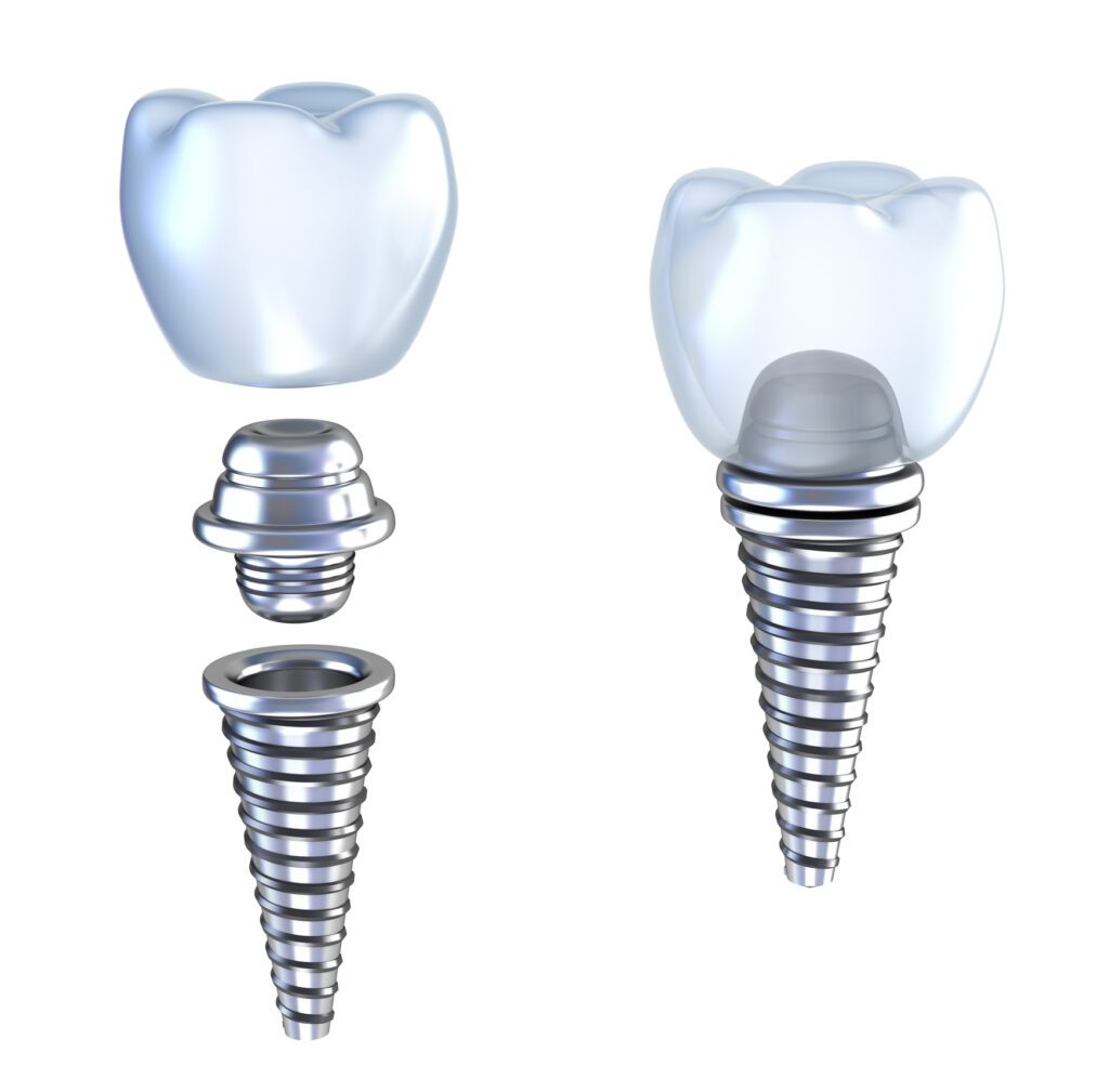 parts of a dental implant from our Argyle, TX dental office