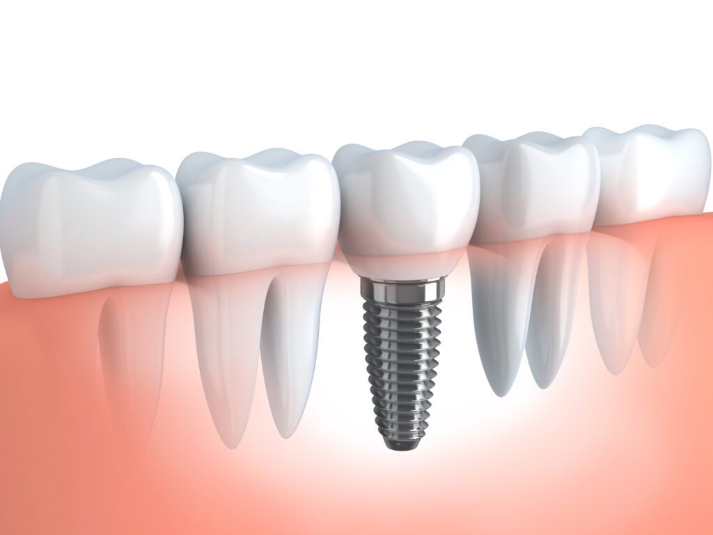 single dental implant in Argyle, TX
